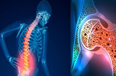 چگونه از  پوکی استخوان جلوگیری کنیم؟